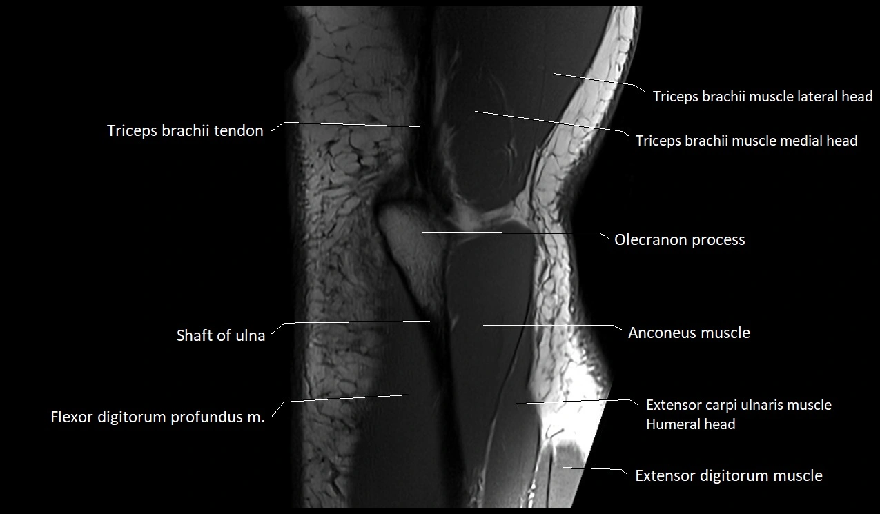 Elbow coronal anatomy image  cross sectional 3T MRI image 29.webp